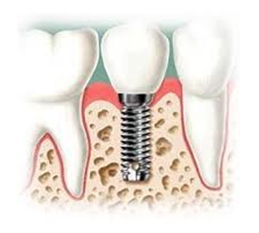 Implantes-dentales-1