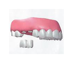 Implantes-dentales-2